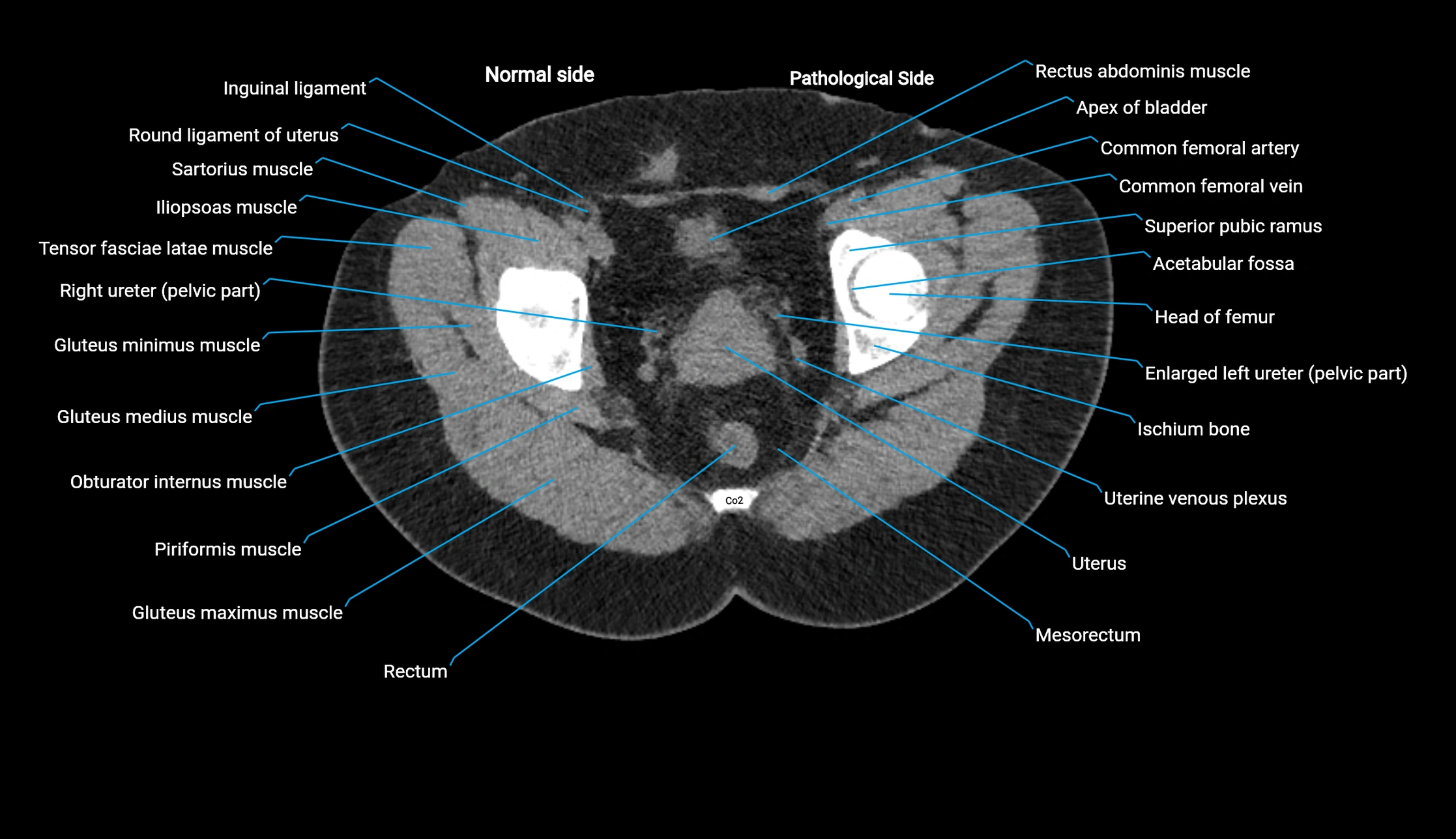 CT KUB axial cross sectional anatomy  radiology image -img-00201-00153.webp